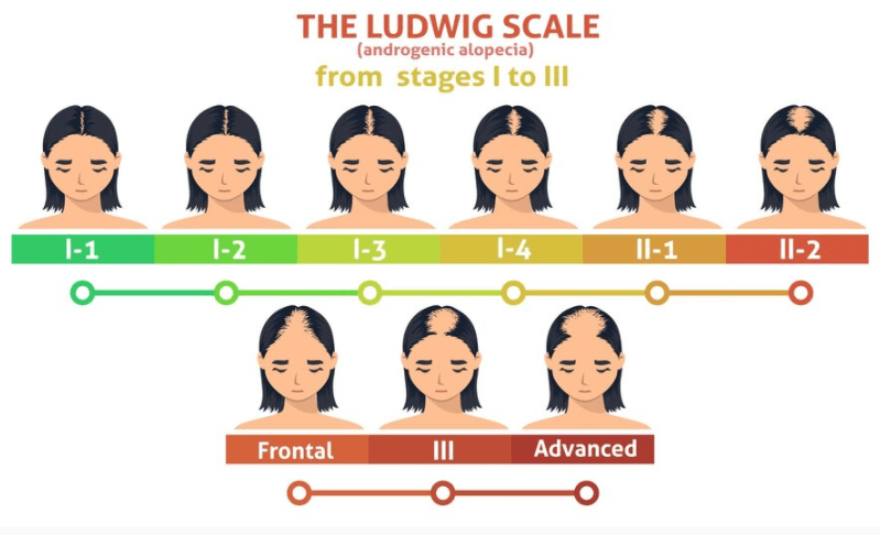 Ludwig scale  Types of hair loss – Neofollics