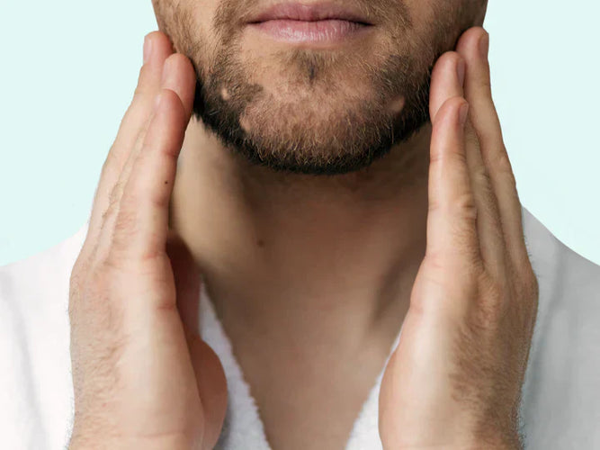 Alopecia barbae: Wat te doen bij kale plekken in je baard