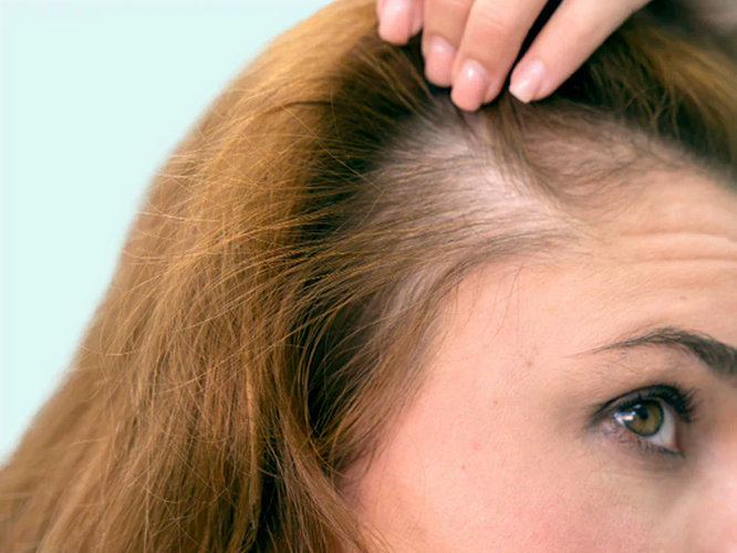 Hair Loss Women