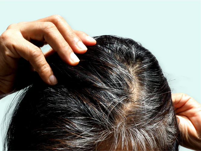 Grey hair: causes, contributing factors and what you can do against it