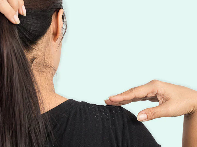 Selsun Shampoo withdrawn from market: what is the alternative?