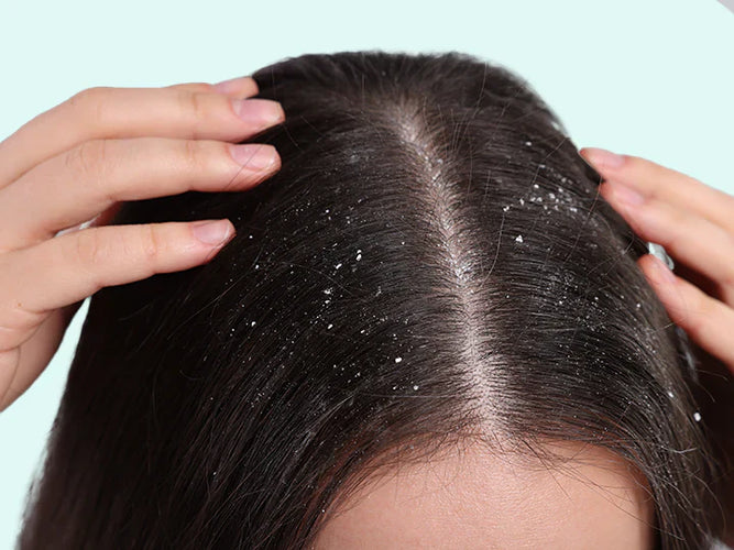Dry and oily dandruff: how to tell the difference and choose the scalp routine