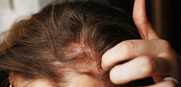 Scalp rash: symptoms and treatments
