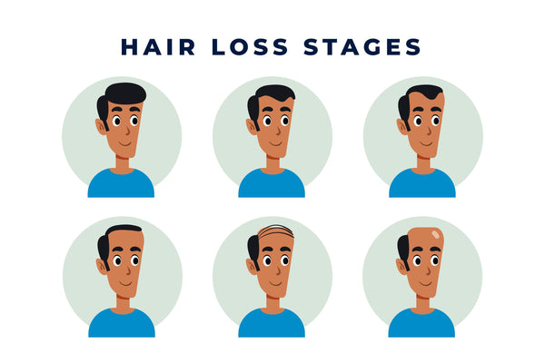 Hair loss types: Androgenetic alopecia | Male pattern baldness | Female pattern baldness