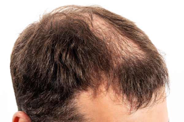 Man with excessive hair loss