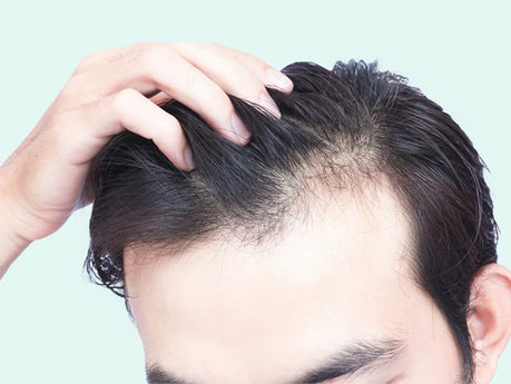 Alopecia androgenetica (erfelijke haaruitval)