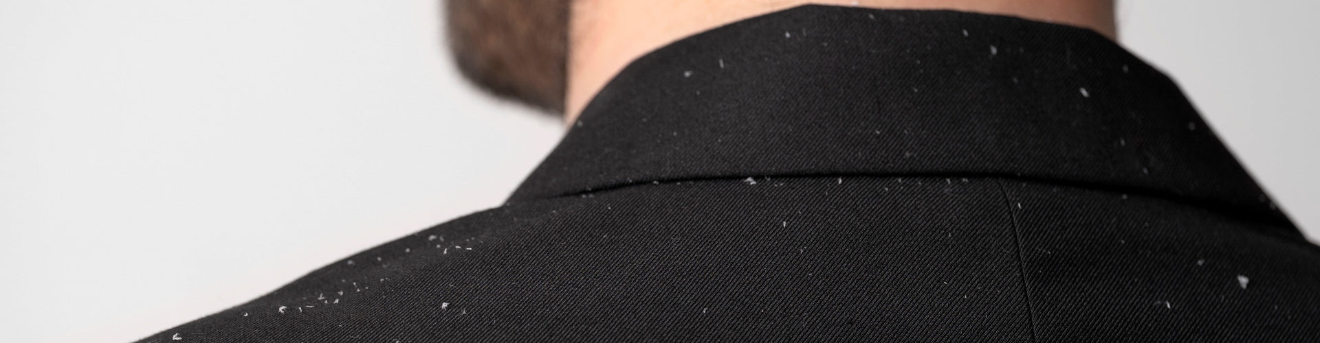 Pityriasis capitis, ofwel haar roos op de hoofdhuid