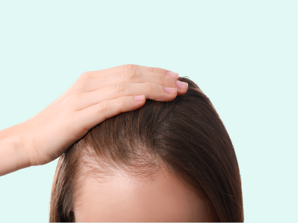 Iron deficiency hair loss/ Anemia hair loss