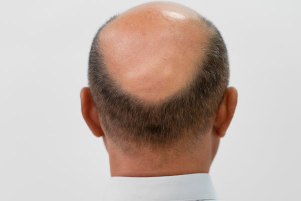 Man with bald top of the head