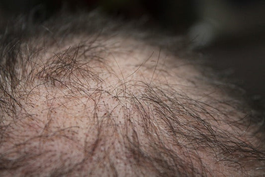 Man with hair loss