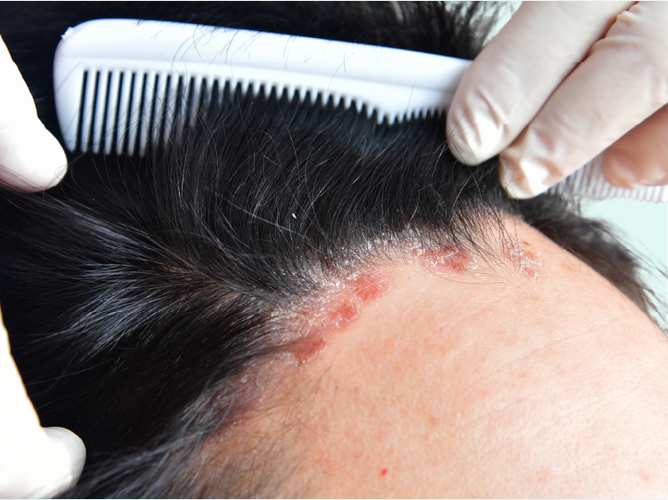 Scalp rash