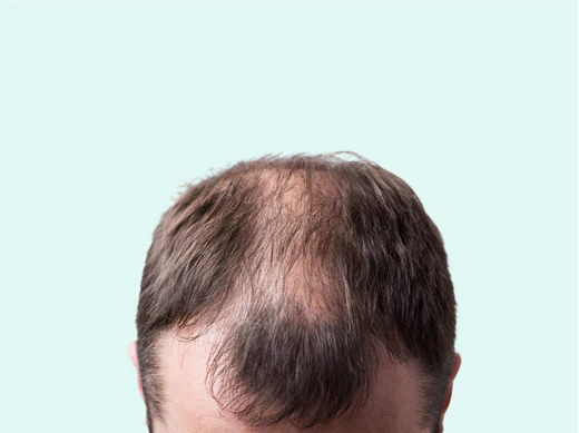 Do steroids cause hair loss?