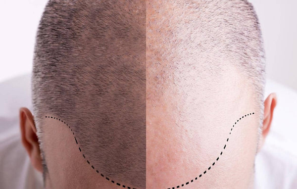 Hair Transplant Recovery