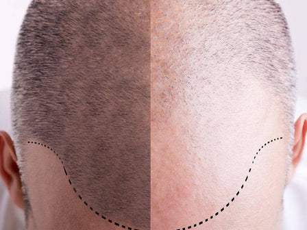 Hair Transplant Recovery