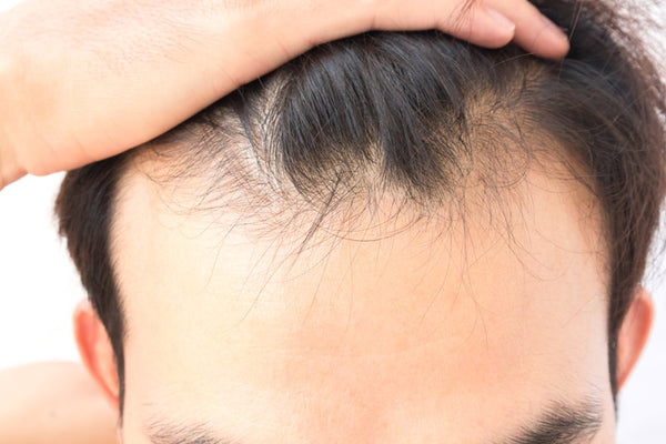 Man pulling back his hair, with uneven hairline