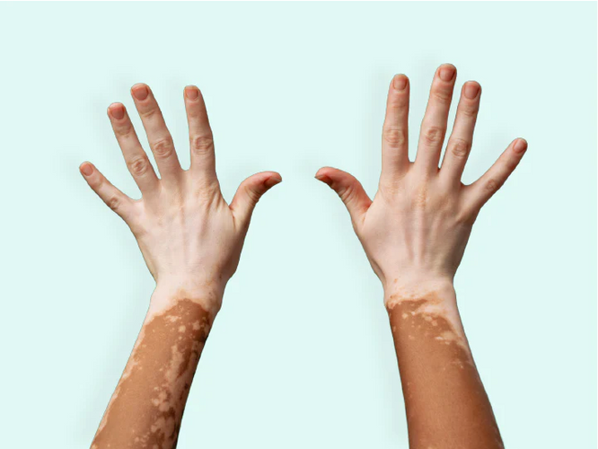 Vitiligo