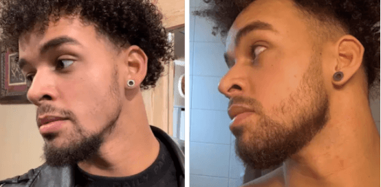 Man before and after Neofollics beard growth treatment
