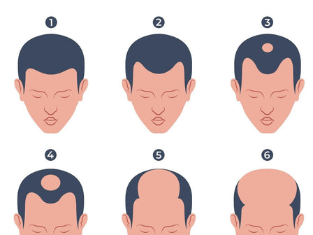 What is the Norwood Scale?