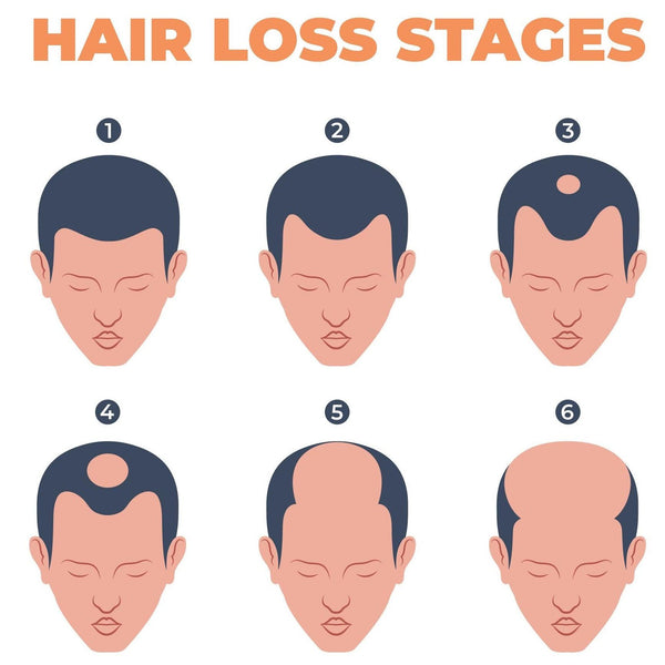 Norwood scale for hair loss stages