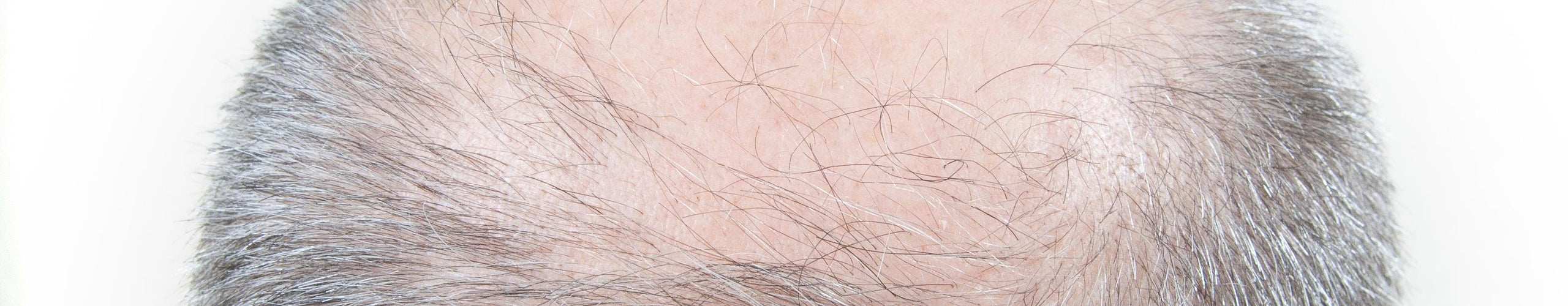 Balding spots on head