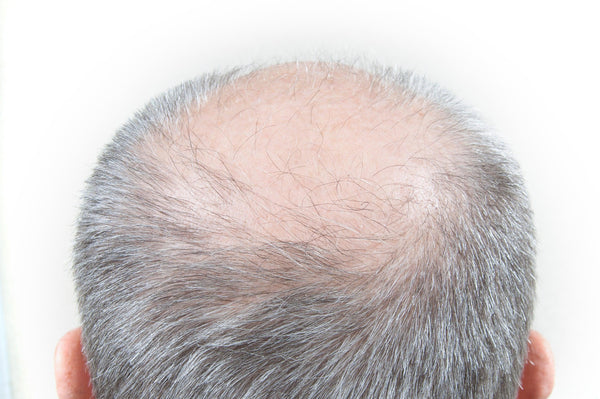 Man with bald spot on the back of his head
