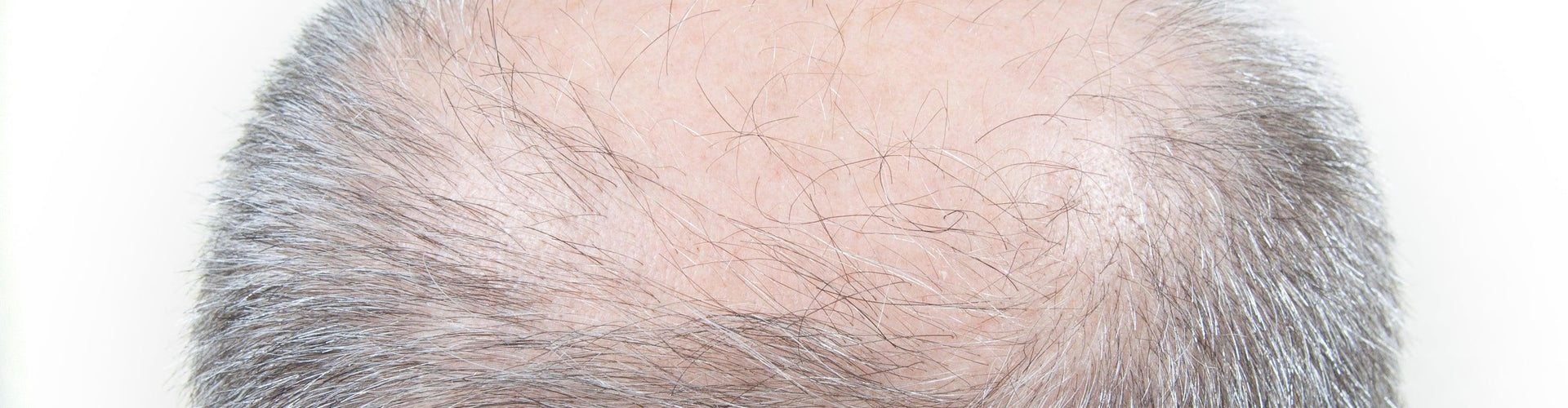 Balding spots on head