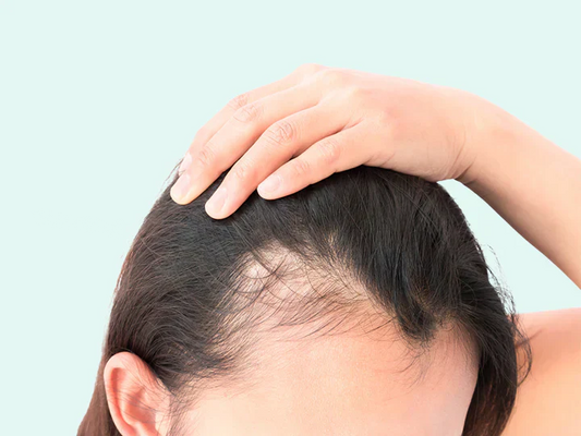 Dihydrotestosterone (DHT) explained and its role in hair loss