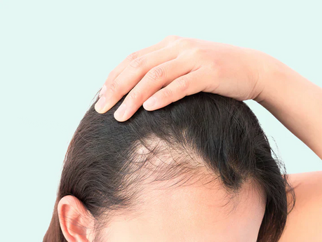 Dihydrotestosterone (DHT) explained and its role in hair loss