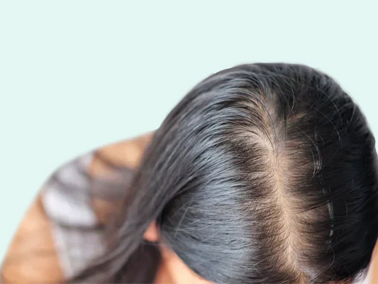 DHT and hair loss in women explained