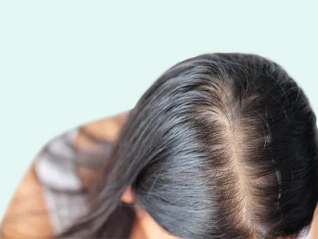 DHT and hair loss in females explained