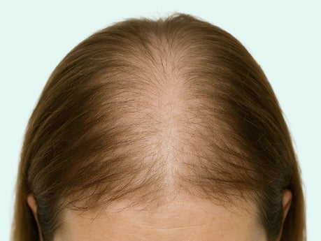 Hair loss after anaesthesia: why you may suddenly lose hair after surgery