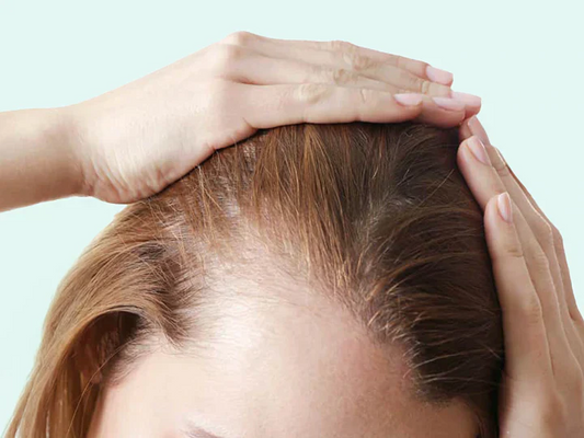 Women with hair loss
