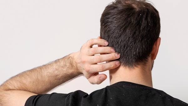 Man touching inflamed scalp