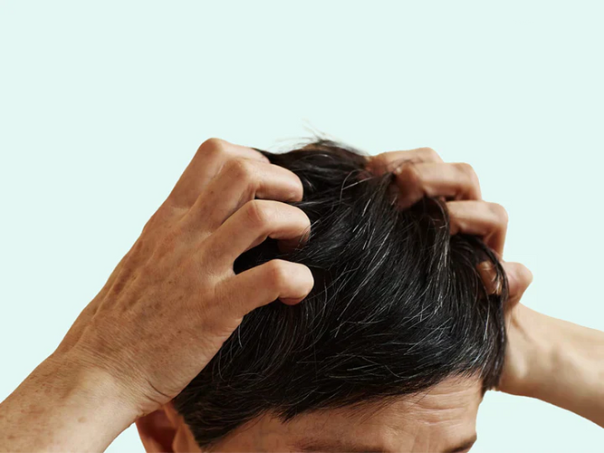 Wat veroorzaakt hoofdhuid psoriasis en wat zijn de symptomen?