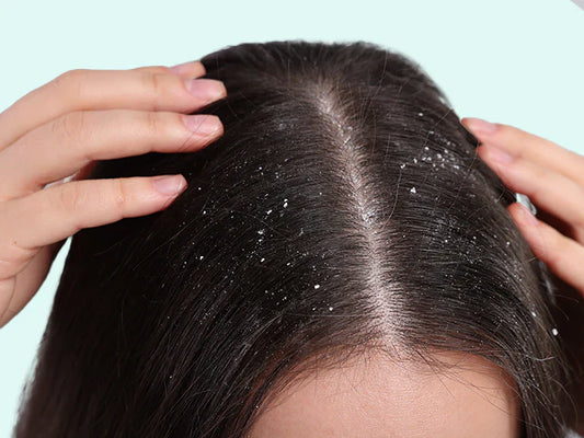 Dry and oily dandruff: how to tell the difference and choose the scalp routine