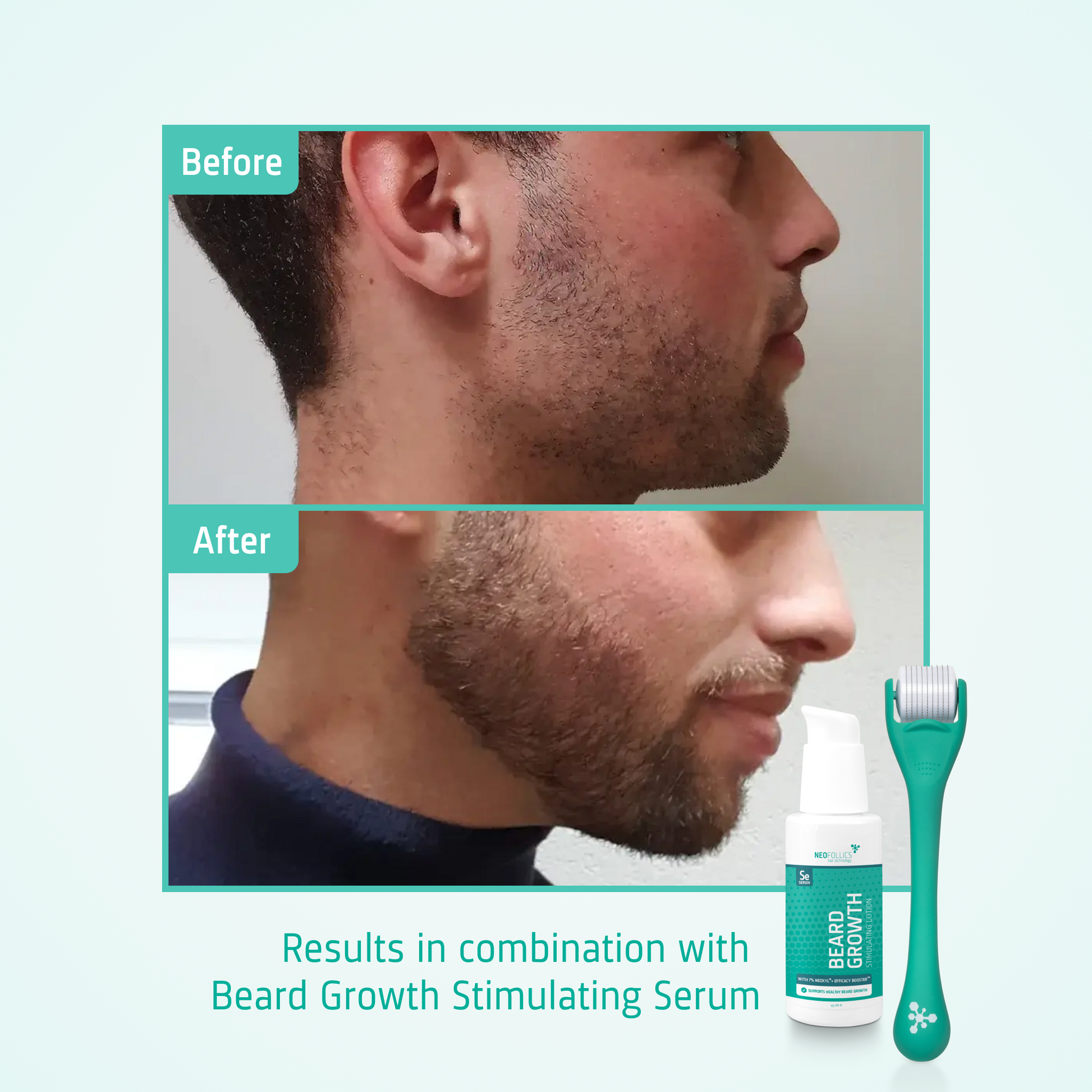 Beard Growth Enhancing Roller before after