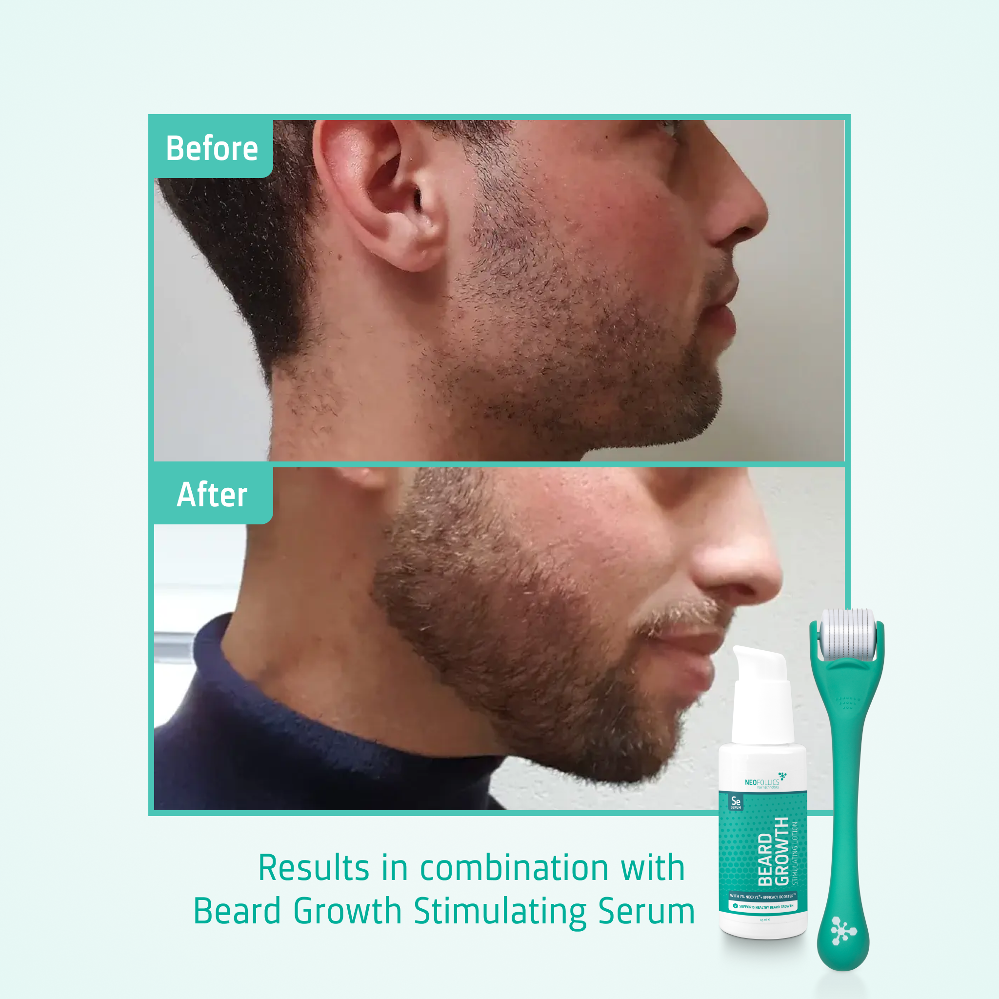 Beard Growth Enhancing Roller before after