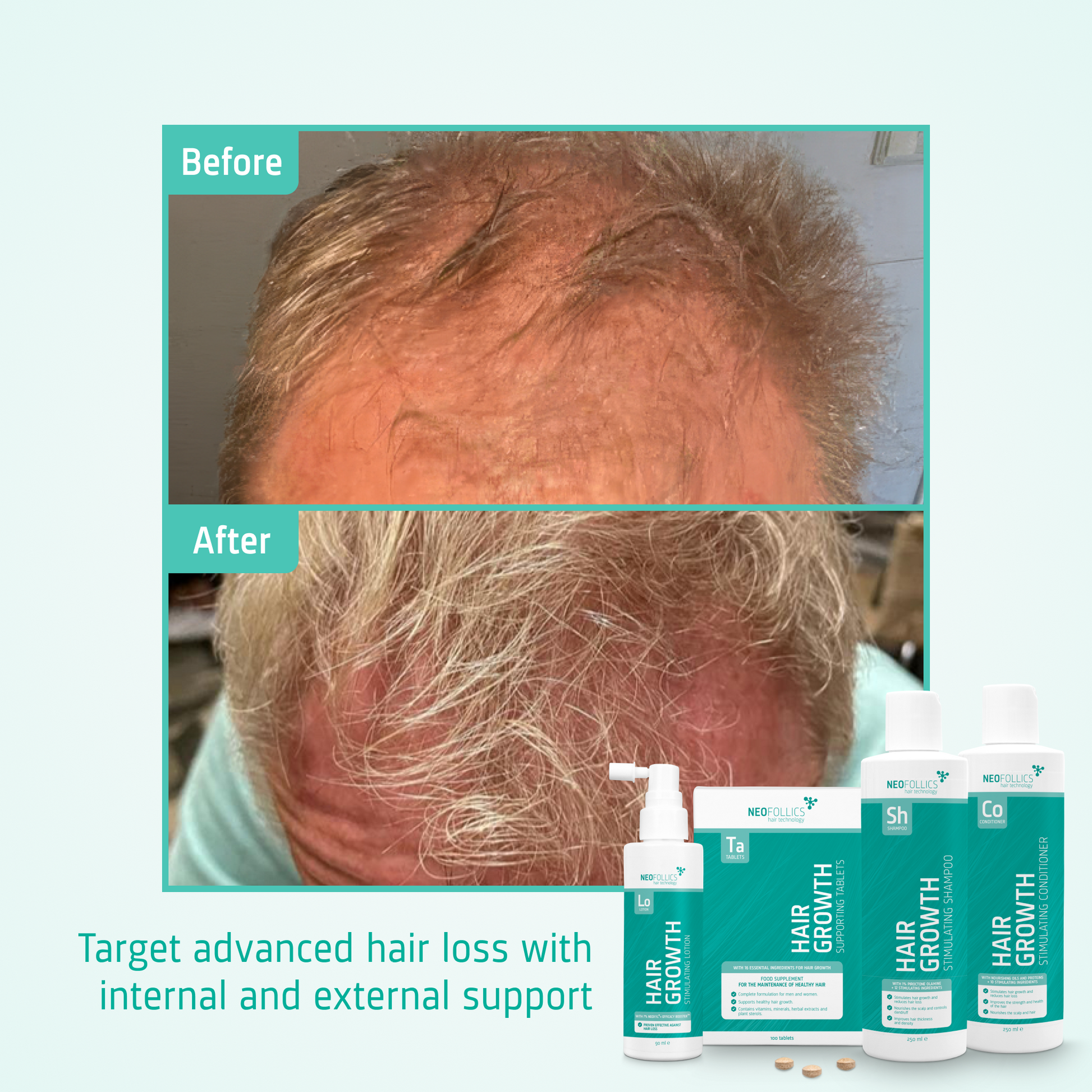 Hair Growth Advanced hair loss routine before after