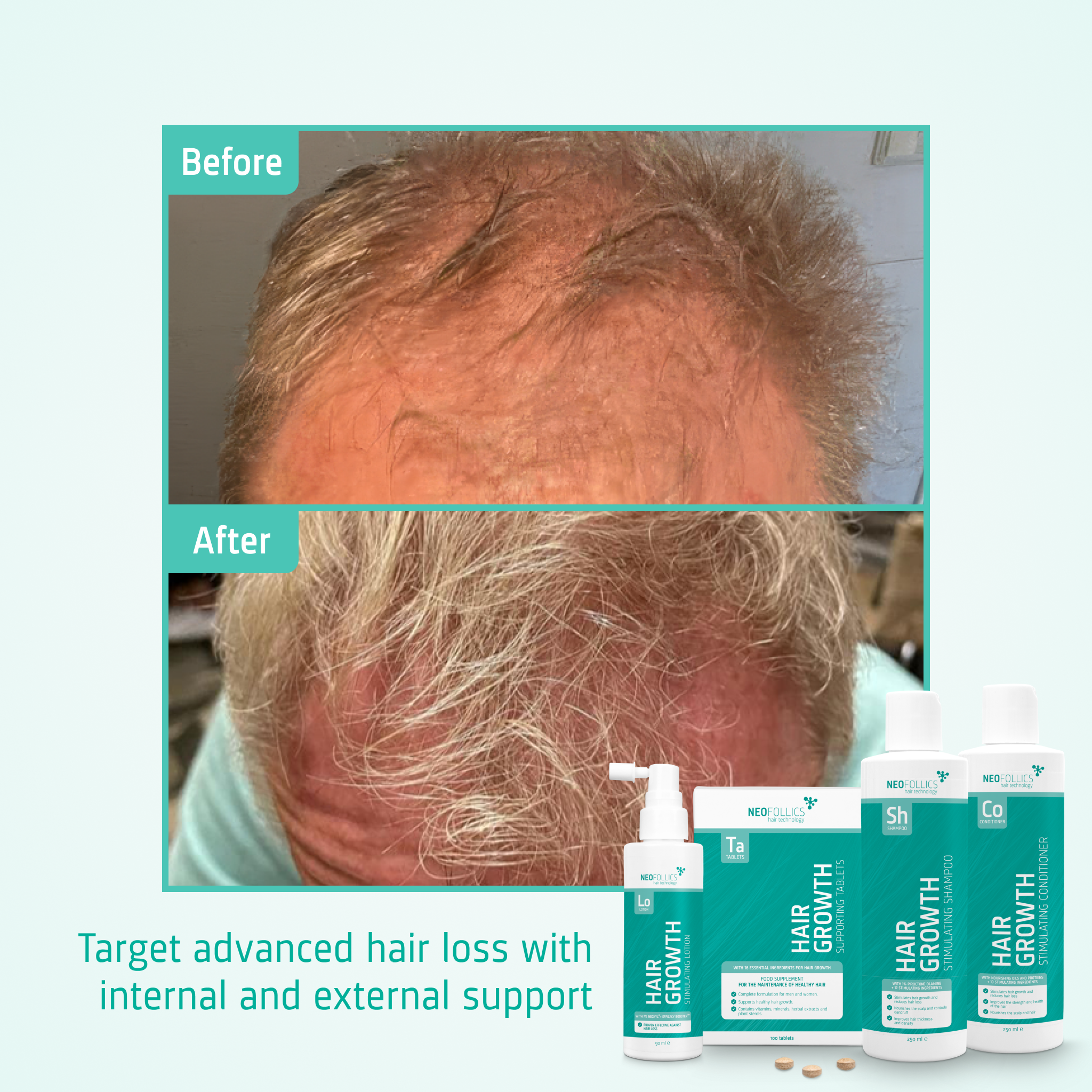 Hair Growth Advanced hair loss routine before after
