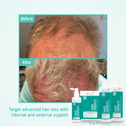 Hair Growth Advanced hair loss routine before after