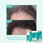 Hair Growth Androgenetic Alopecia routine before after