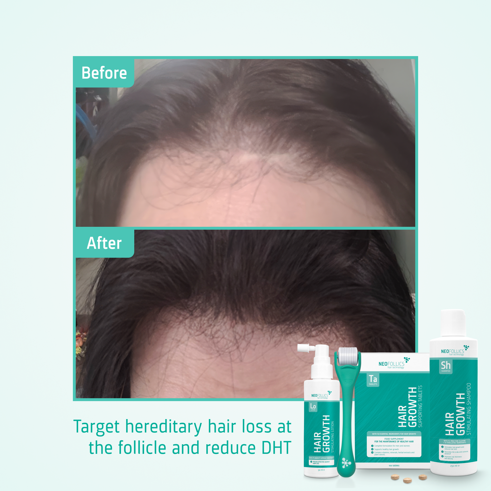 Hair Growth Androgenetic Alopecia routine before after