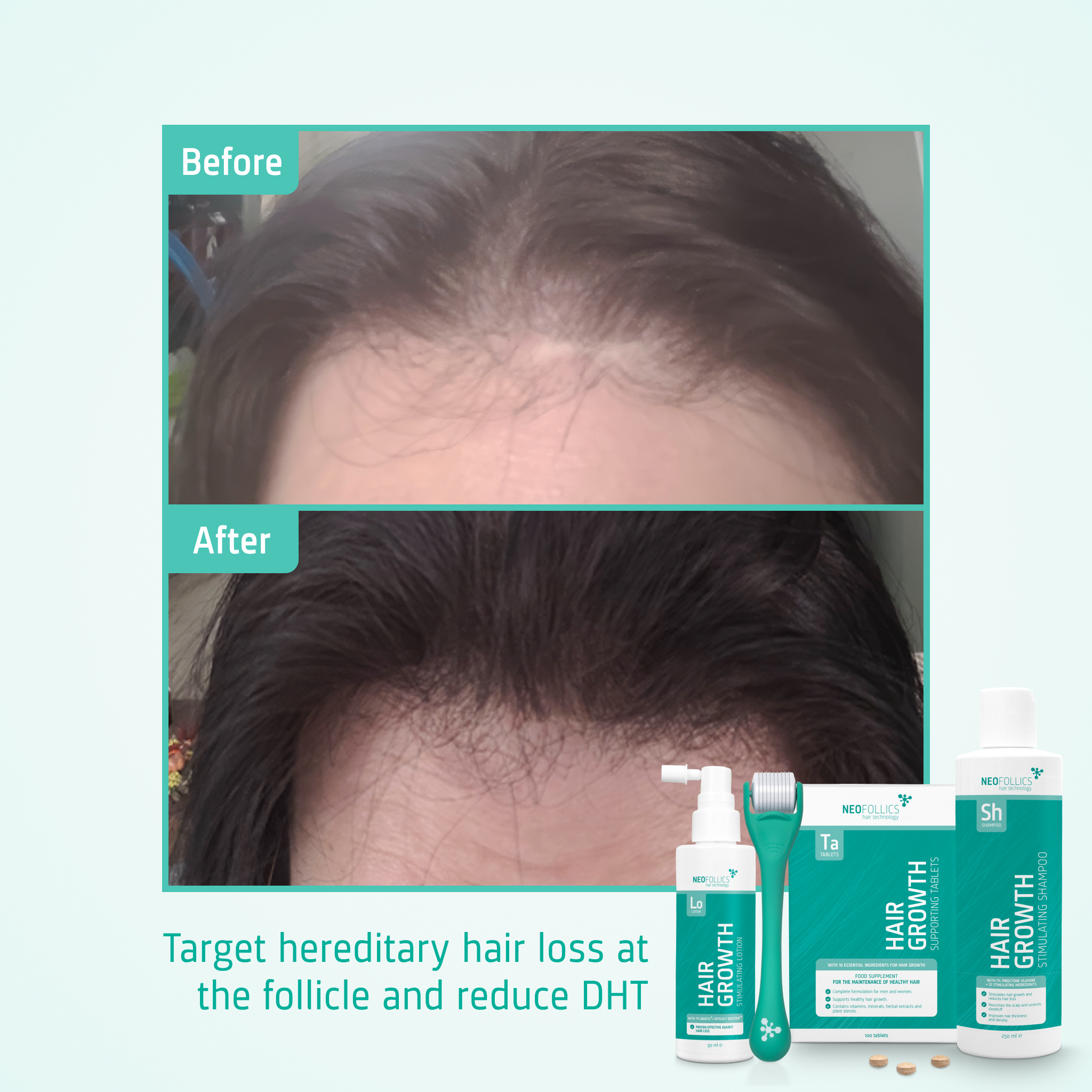 Hair Growth Androgenetic Alopecia routine before after