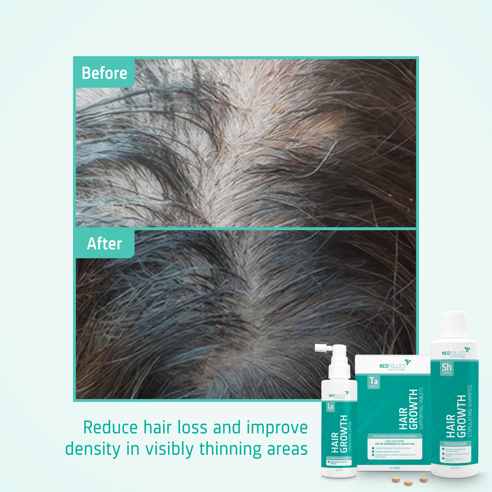 Hair Growth Moderate hair loss routine before after