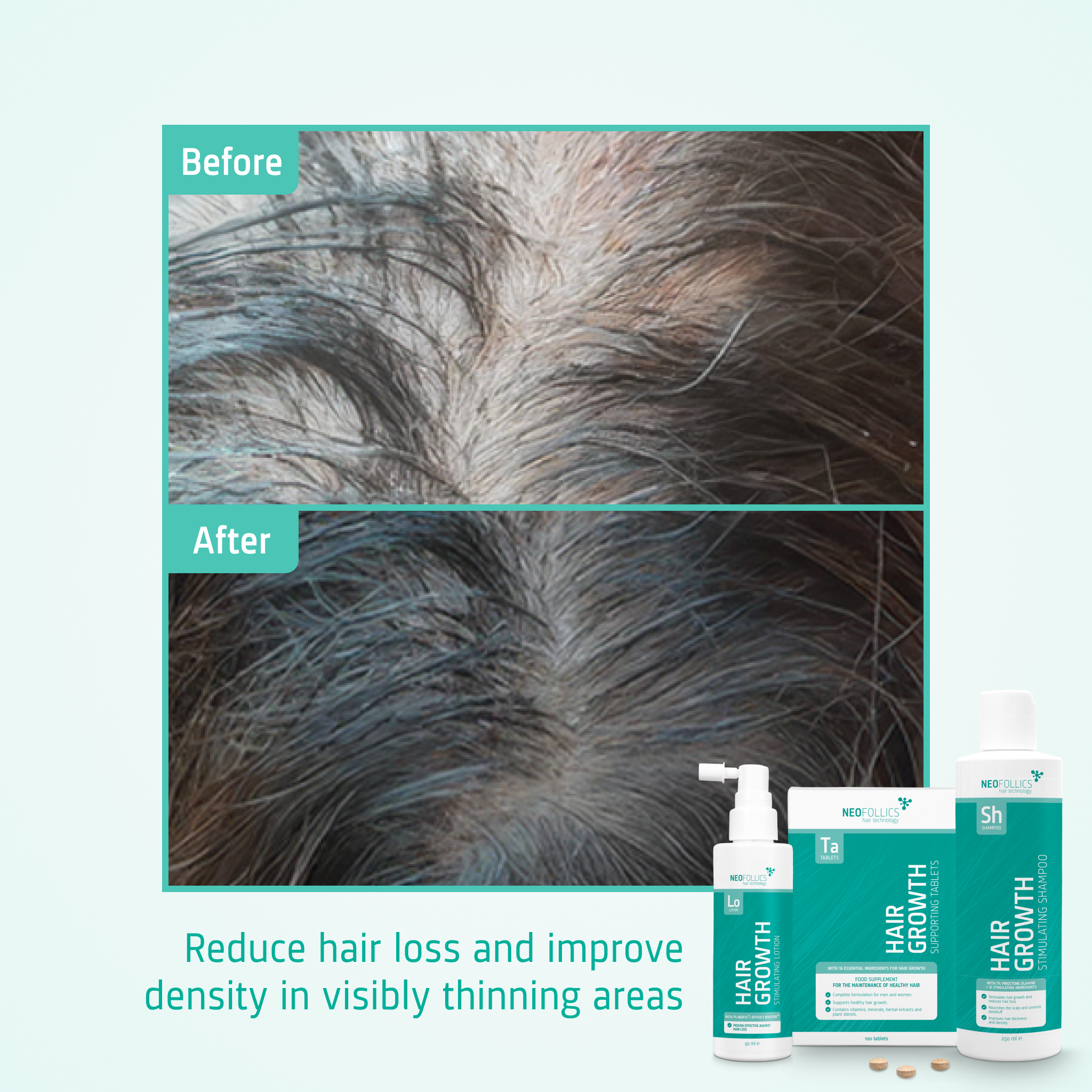 Hair Growth Moderate hair loss routine before after