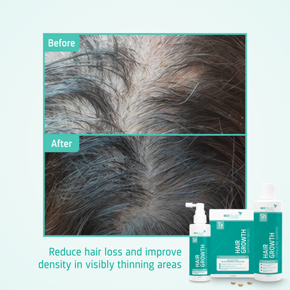 Hair Growth Moderate hair loss routine before after