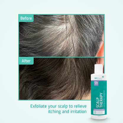 Scalp Therapy Exfoliating Shampoo before after