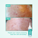 Scalp Therapy Peeling Serum before after