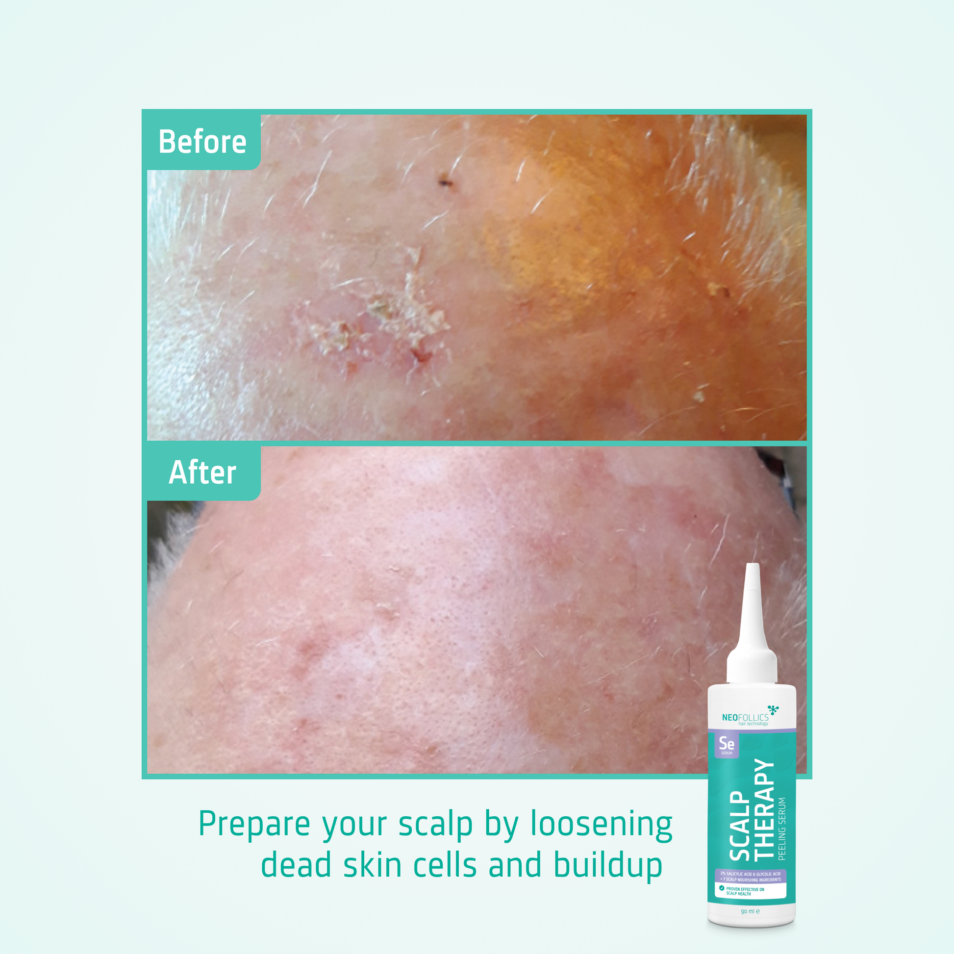 Scalp Therapy Peeling Serum before after