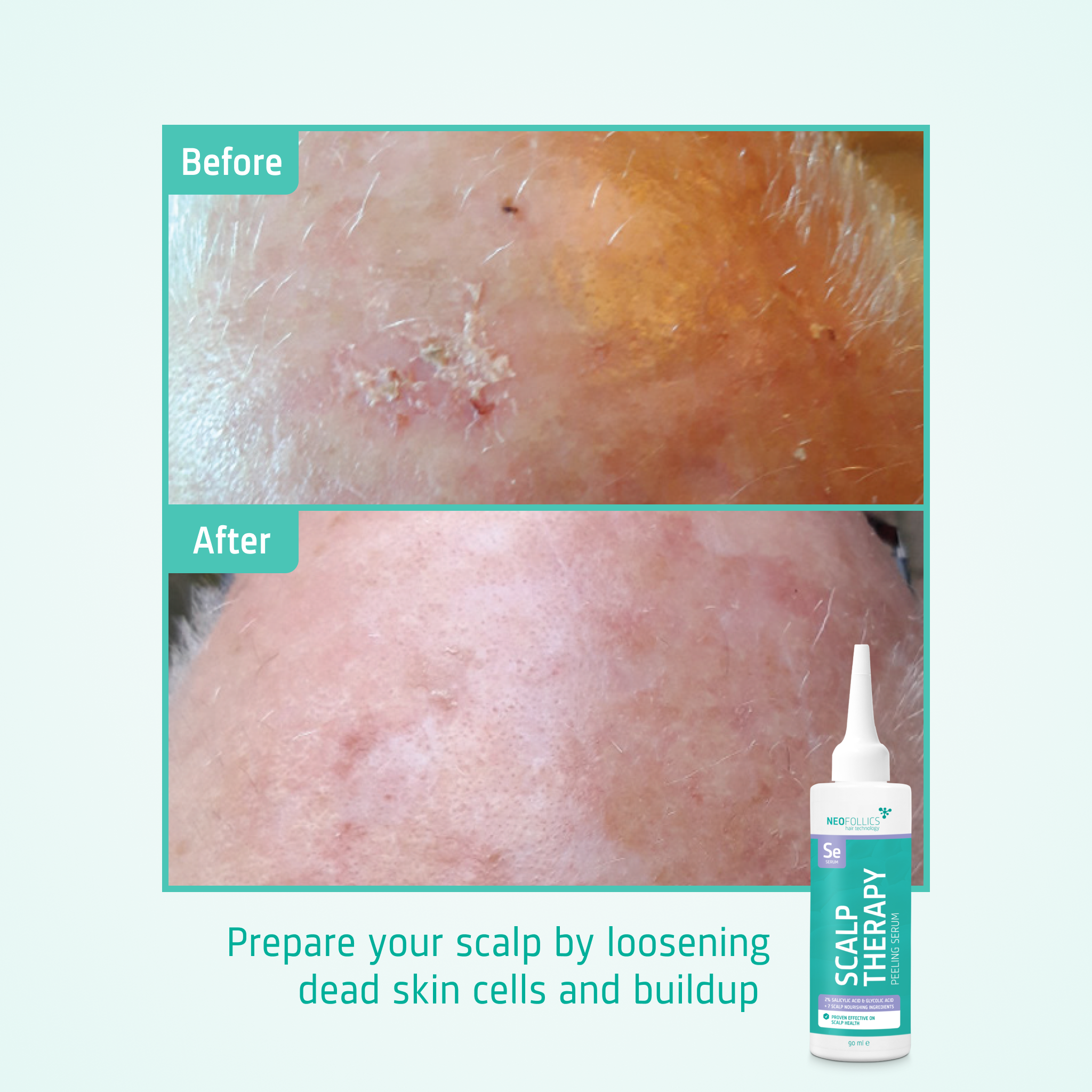 Scalp Therapy Peeling Serum before after